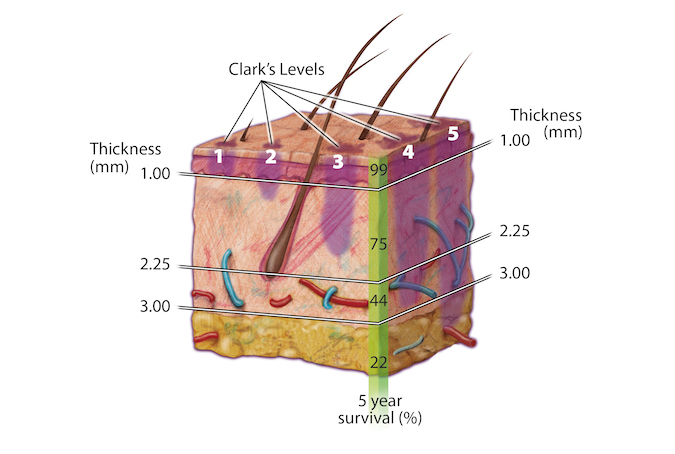 Clark's level is determined by the depth of the melanoma cells in the dermis.  Breslow thickness measures the thickness of the lesion in the skin which defines the surgical margins and helps predict the five year survival rate. (references 3-8).