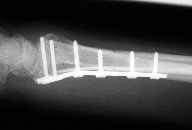 Internally fixed distal radius fracture lateral view
