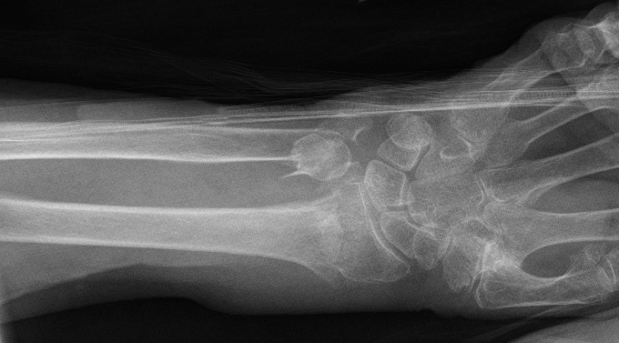 Unreduced classic Colles' Fracture AP view