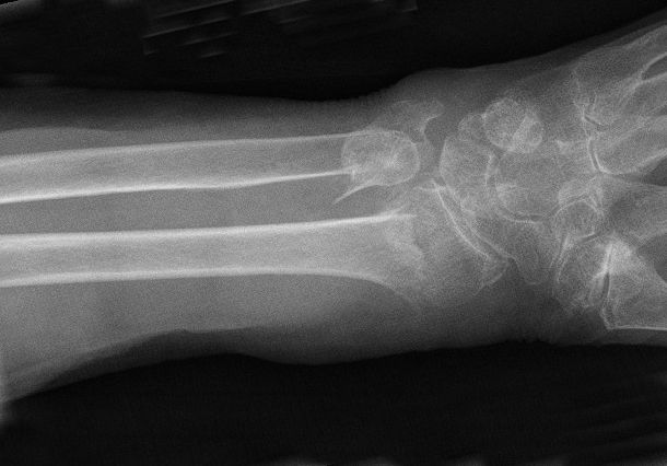 Classic Colles' Fracture Oblique view  Note ulna head also fractured