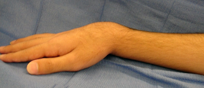 Silver Fork Deformity Secondary to Distal radius Fracture