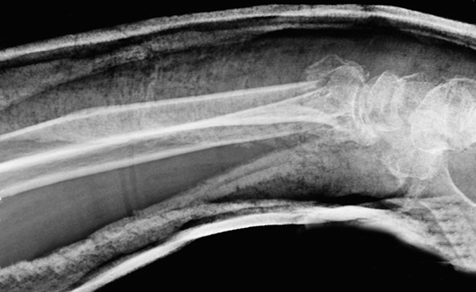 Lateral X-ray of a distal radius fracture in a short -rm cast. Alignment acceptable
