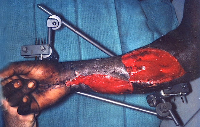 Compartment Syndrome after Fasciotomy and External Fixation