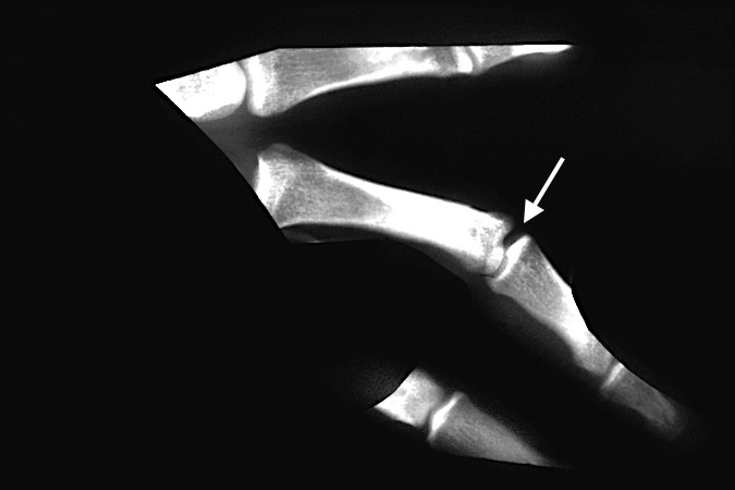 Complex dislocations AP X-ray views often show a widened joint space (arrow).