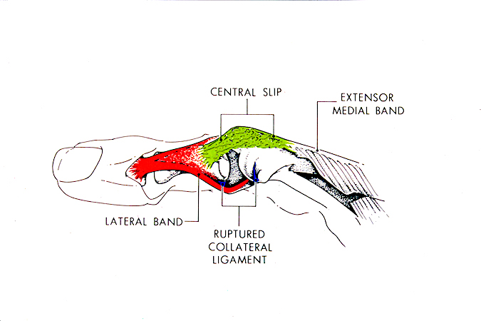Complex PIP Dislocation by Lateral Band: the mechanism of injury involves flexion and torsion which splits the lateral band off the central slip, forces the band over the proximal phalanx condyle and into the PIP joint with the central slip remaining intact.