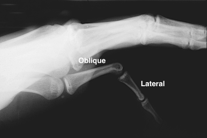 Complex dislocations frequently have a rotational component, therefore the lateral X-ray may look half like an oblique view and half like a true lateral view.