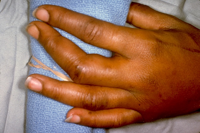 Complex Dislocation left long finger - Closed reduction not possible. These rare complex (irreducible by closed methods) PIP dislocations usually occur in the ring and little fingers.  The mechanism of the volar complex PIP dislocations involves deviation, flexion and torsion. Approximately 1/5 of the reported complex dislocations are open.  Delayed presentation is common.