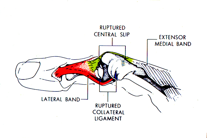 Complex PIP Dislocation by Lateral Band & Ruptured Central Slip: the mechanism of injury involves flexion and torsion which splits the lateral band off the central slip, forces the band over the proximal phalanx condyle and into the PIP joint with a ruptured central slip.