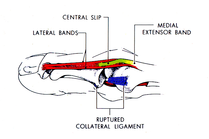 The first stage of a complex PIP dislocation is a deviation force which ruptures the collateral ligament. This is followed by flexion and torsion which splits the lateral band off the central slip, forces the band over the proximal phalanx condyle and into the PIP joint.