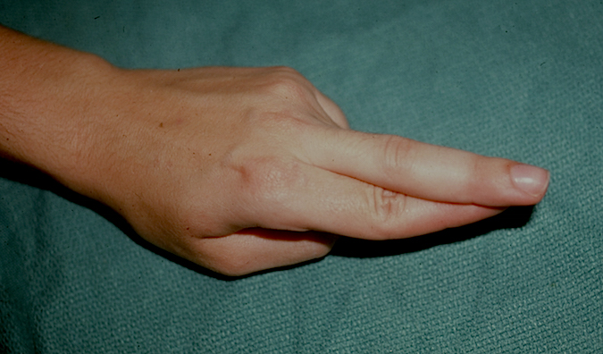 Normal cross finger test which patient can do because the ulnar innervated intrinsics are functioning normally.