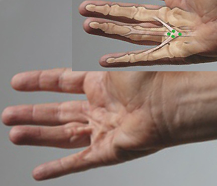 Central cord and two natatory cords combining to form a "crow's foot" cord and contract the MP joints of three adjacent fingers. Targets for collgenase in green.