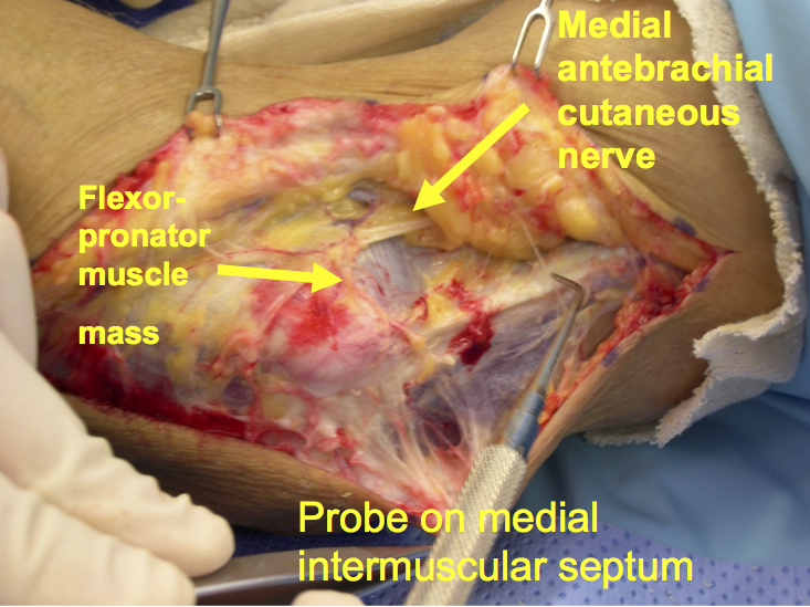 Cubital Tunnel Syndrome Anatomic Relations-Ulnar Nerve Under fascia below epicondyle and posterior to intramuscular septum edge