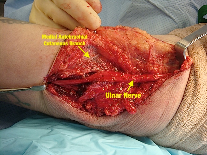 Cubital Tunnel Syndrome - Subcutaneous transposition of the ulnar nerve