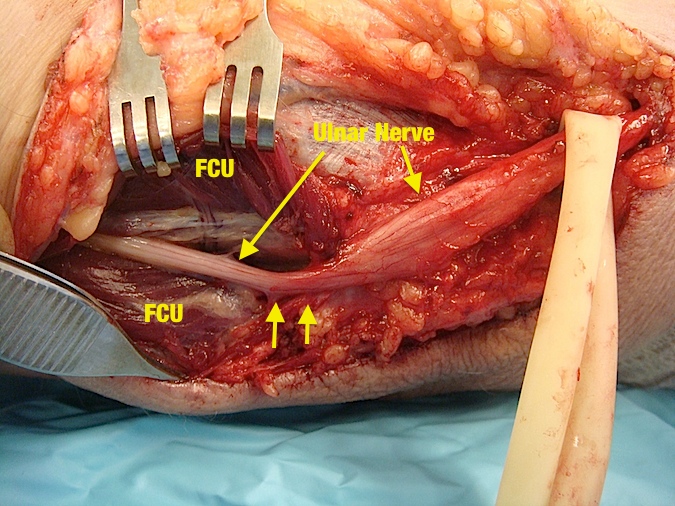 Cubital Tunnel Syndrome: Double arrow was the point of constriction caused by Osborne's ligament and proximal FCU sheath. Proximal swelling consistent with "Pseudoneuroma" of ulnar nerve entrapment