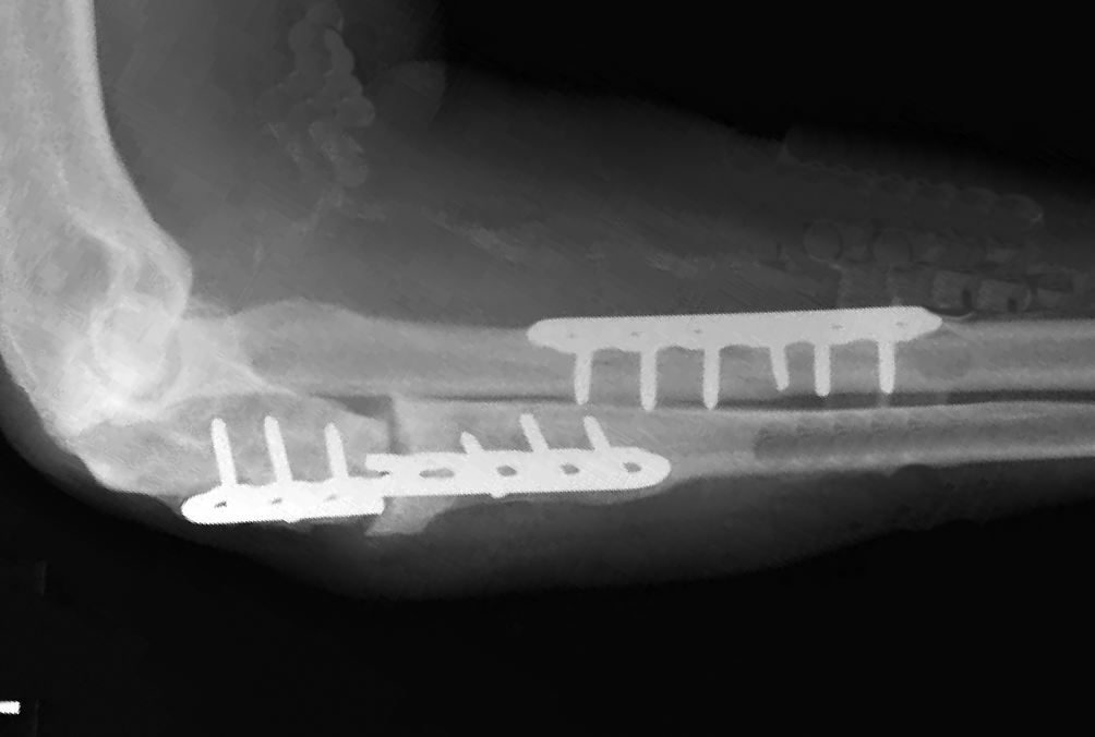 Broken plate secondary to non-union of the ulna