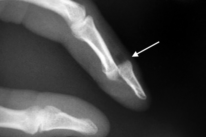 DIP Dislocation (arrow) - bayonet type base of distal phalanx is displaced on top of the neck of the middle phalanx.