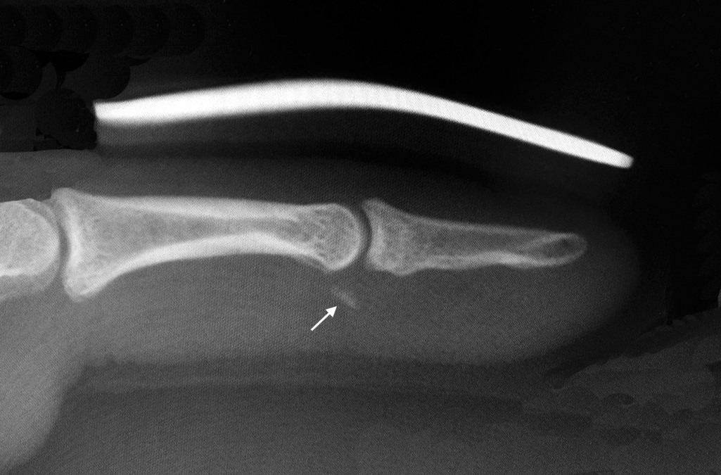DIP Joint Dislocation after closed reduction and application of a dorsal splint.  Note small volar plate avulsion fracture fragment (arrow).