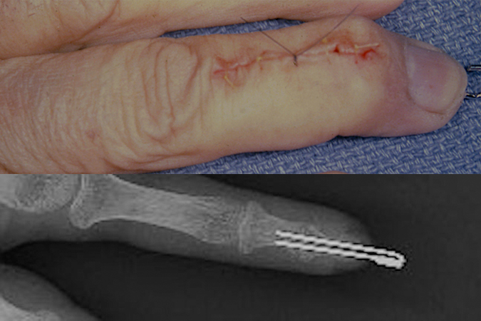Fusion of little finger DIP joint for pain secondary to OA.