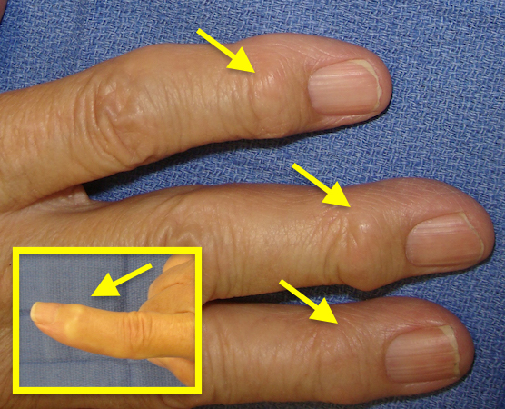 Classic appearance of OA involving the DIP joints (arrows).  These DIP OA findings are called Herberden's Nodules.
