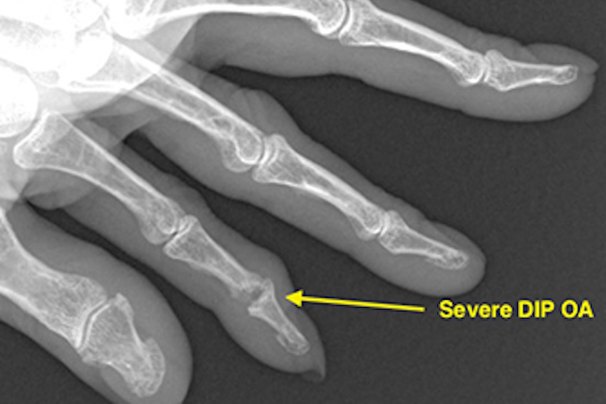 Severe index DIP OA with bone loss (arrow).