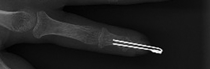 Psoriatic arthritis - Pencil-in-cup deformity of the DIP joint treated with a DIP arthrodesis.  Note bone graft not needed in this case.
