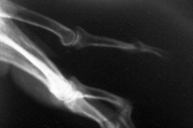 Psoriatic arthritis - Pencil-in-cup deformity of the DIP joint