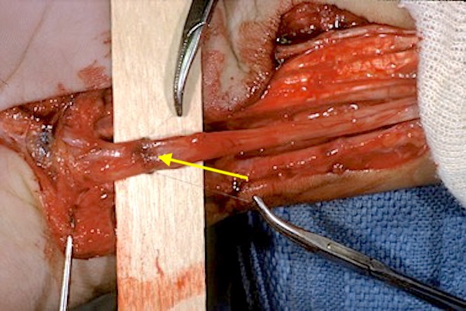 Laceration Median Nerve (arrow) undergoing microsurgical repair.