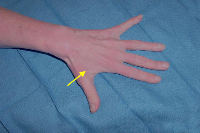 Note ulnar intrinsic atrophy (arrow) caused by Guyon's Entrapment at Zone II.