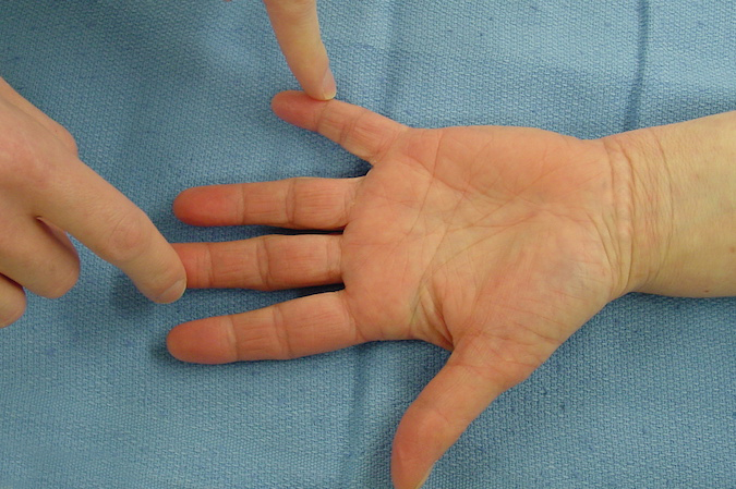 Testing median nerve sensation in long finger and comparing it to ulnar sensation in the little finger.