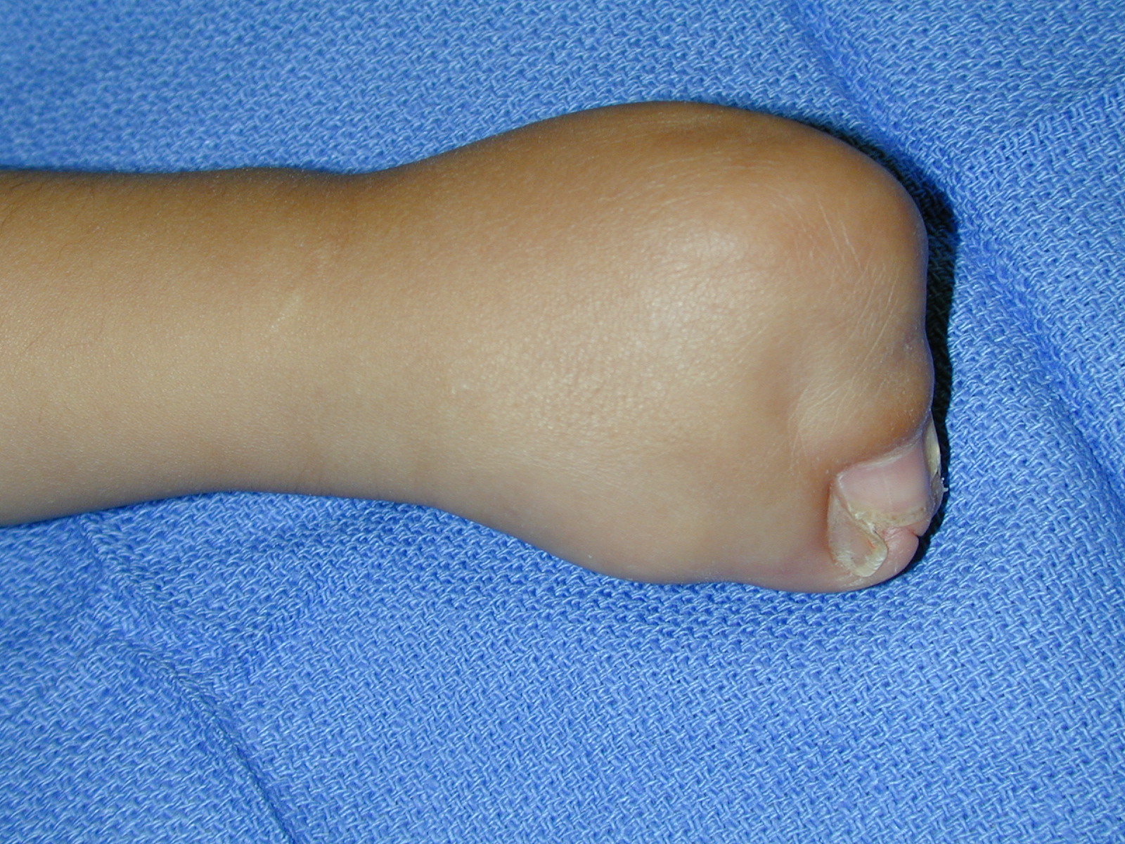 Apert's Syndrome Left Hand dorsum