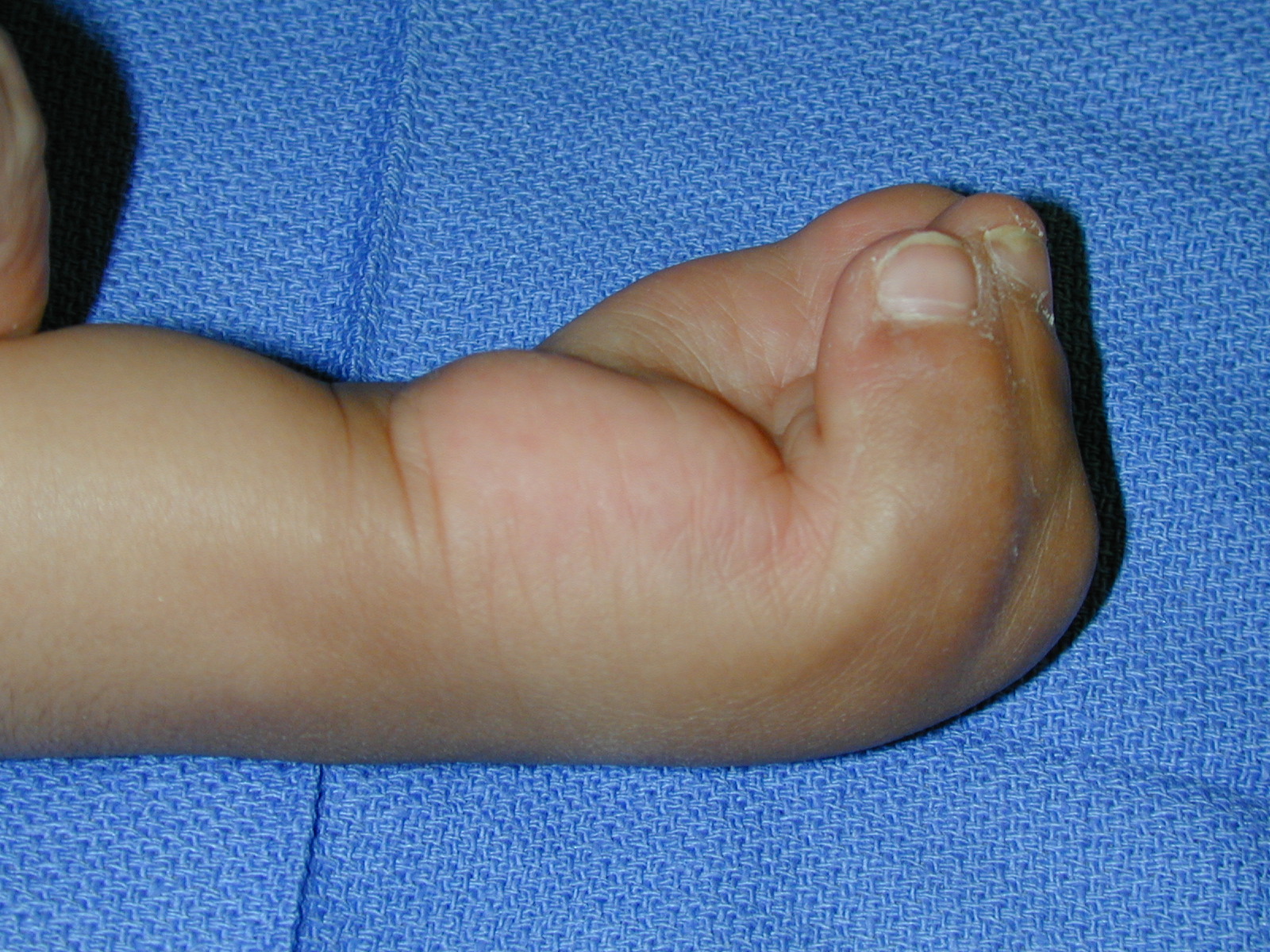 Apert's Syndrome Left Hand ulnar view