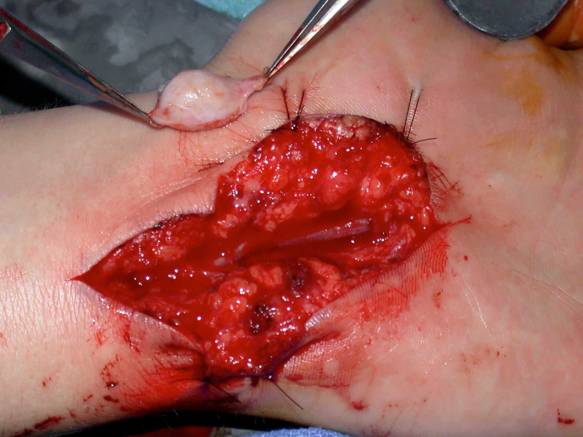 Ulnar Artery Aneurysm