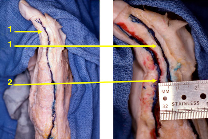 Anatomic dissection showing the dorsal ulnar sensory nerve (1) and the little finger ulnar digital nerve (2).