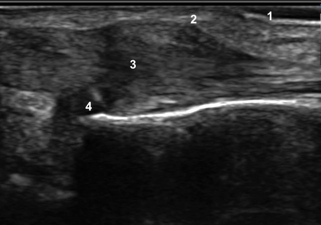 Longitudinal ultrasound image of first extensor compartment in patient with DeQuervain’s Tenosynovitis: 1=skin; 2=extensor compartment thicken fascial sheath; 3=degenerated enlarged extensor tendons with intratendinous fluid; 4=distal radius