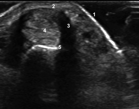 Transverse ultrasound image of first extensor compartment in patient with DeQuervain’s Tenosynovitis: 1=skin; 2= thicken first extensor compartment fascia; 3=fluid in first compartment; 4=extensor tendons- EPB&ABPL; 5=distal radius
