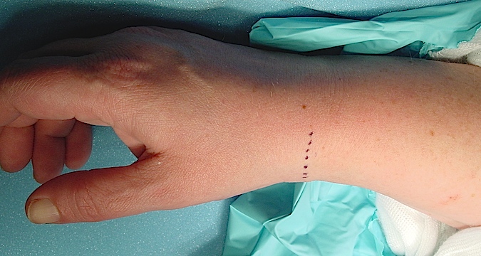 Transverse incision in Langer's lines just distal to the tip of the radial styloid