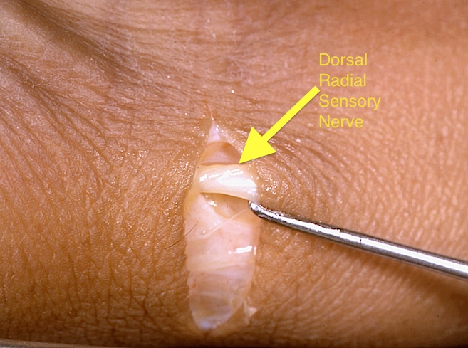 Transverse incision in Langer's lines just distal to the tip of the radial styloid incision made. Note dorsal radial sensory nerve in subcutaneous tissue superficial to first extensor fascia.