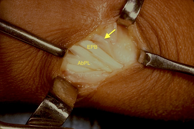 First extensor fascia released. Note multiple tendons because AbPL has from 2-7 slips and EPB has one slip.
