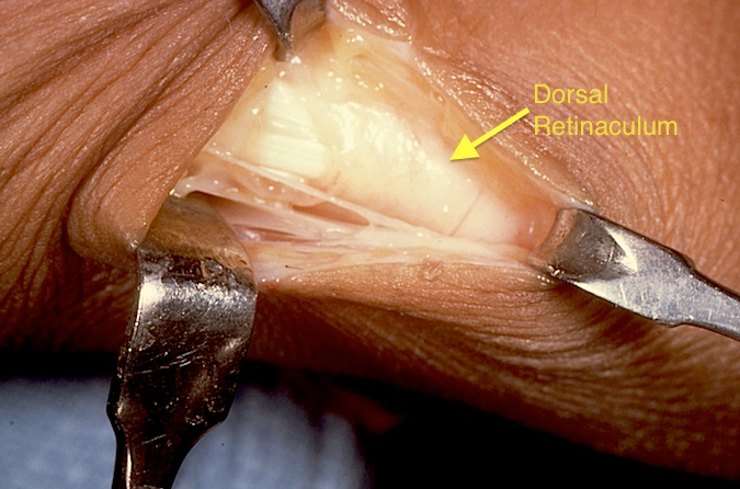 First extensor compartment fascia exposed.