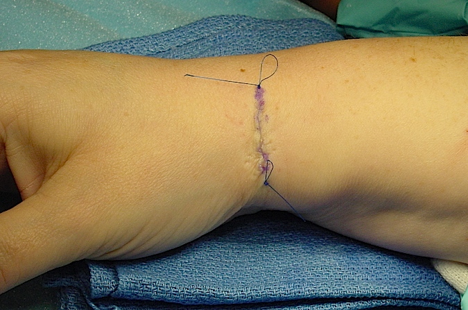 Incision closed with subcuticular proline suture