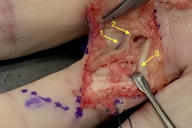 Digital artery passing dorsal to the digital nerve (1); digital nerve (2); Flexor tendon with partial attritional rupture