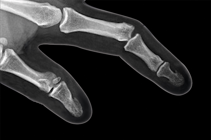 Lateral PIP Dislocation