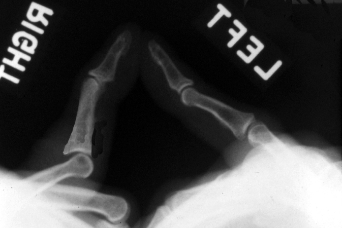 X-ray dorsal hyperextension type PIP dislocation right fifth finger