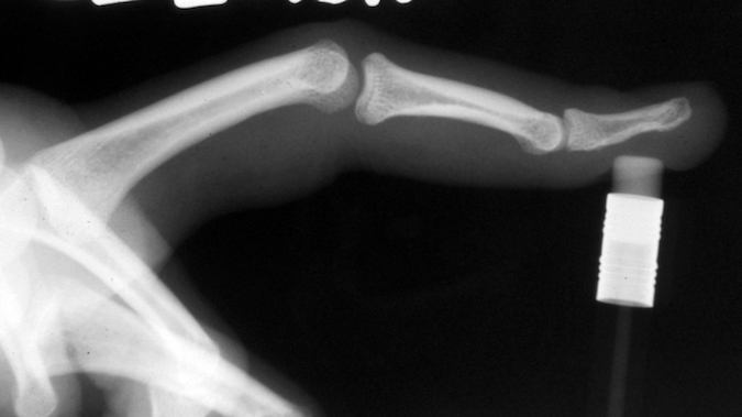 Always take a post-reduction X-ray to verify and document the reduction and rule out any missed fractures.
