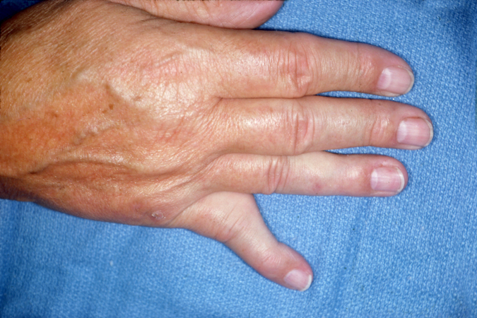 Lateral Chronic PIP Dislocation left fifth finger