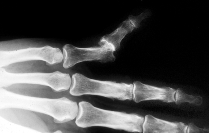 X-ray chronic lateral PIP dislocation left fifth finger