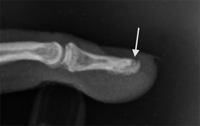 Distal phalanx tuft fracture (arrow) lateral view