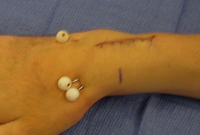 Incision healing well, pins secure and deformity corrected