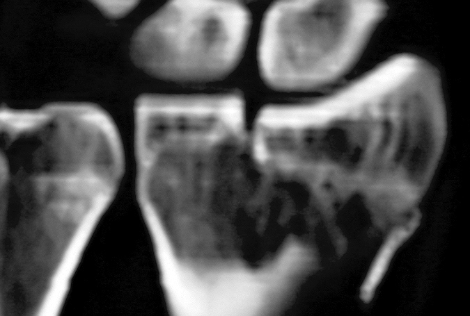 Intra-articular displaced distal radius fracture
