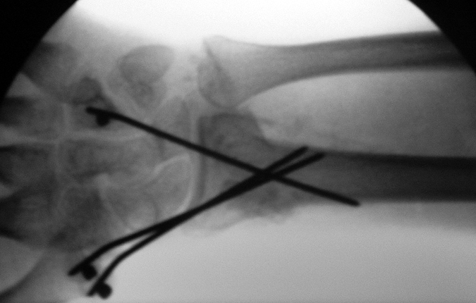 Fracture after open reduction and internal fixation with percutaneous pins